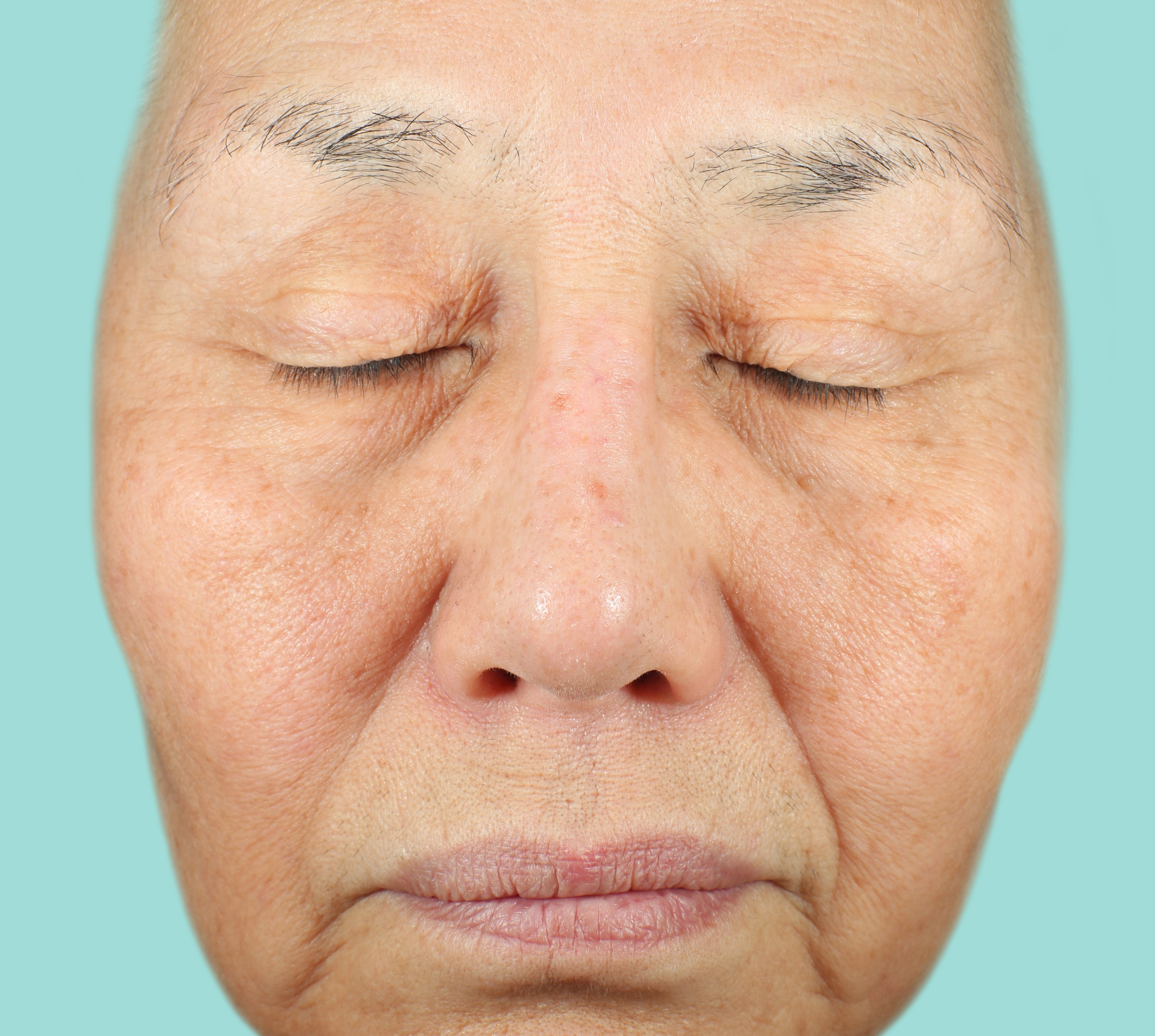 MLK Baseline before NEOCUTIS® treatment