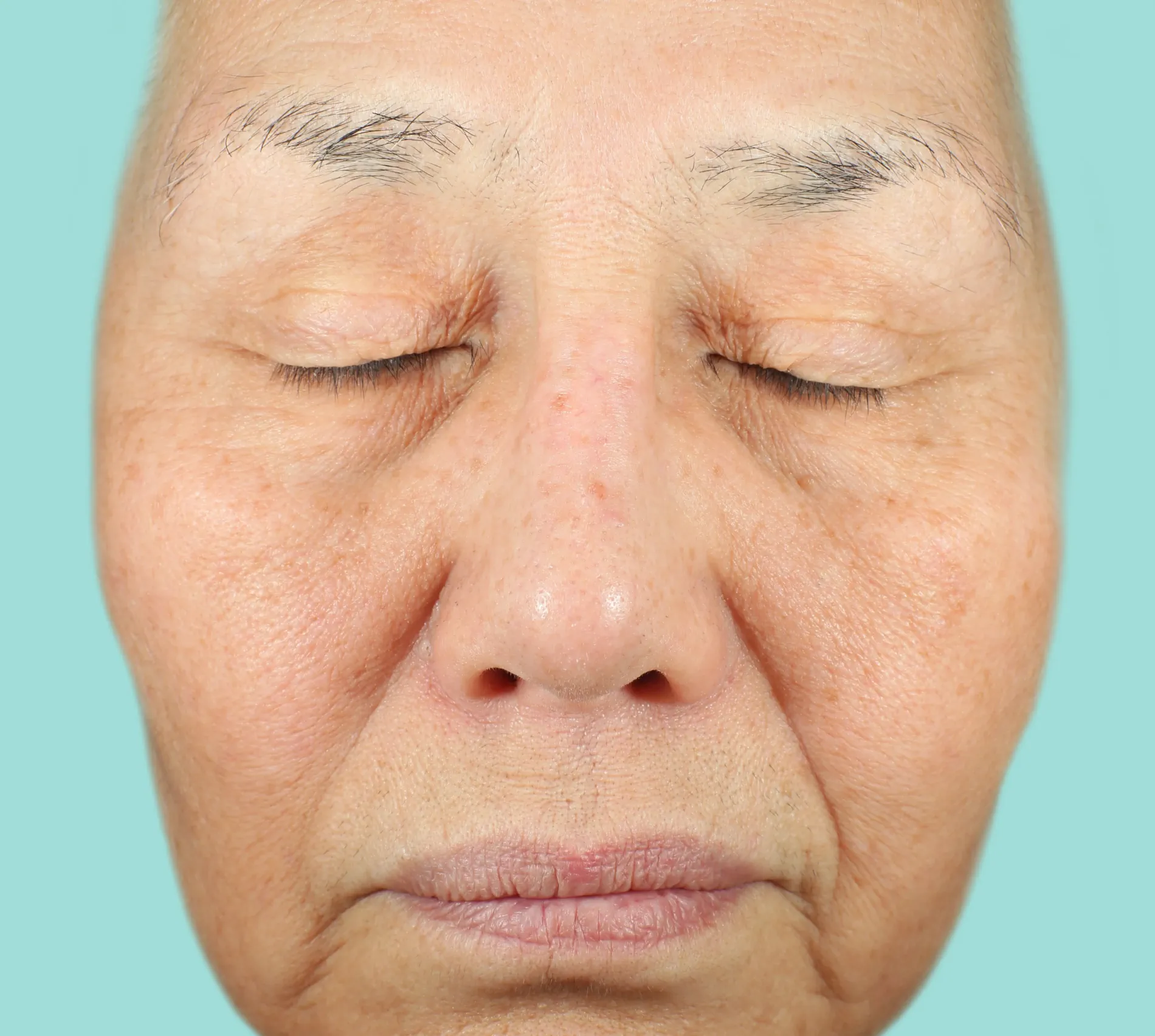 MLK Baseline before NEOCUTIS® treatment