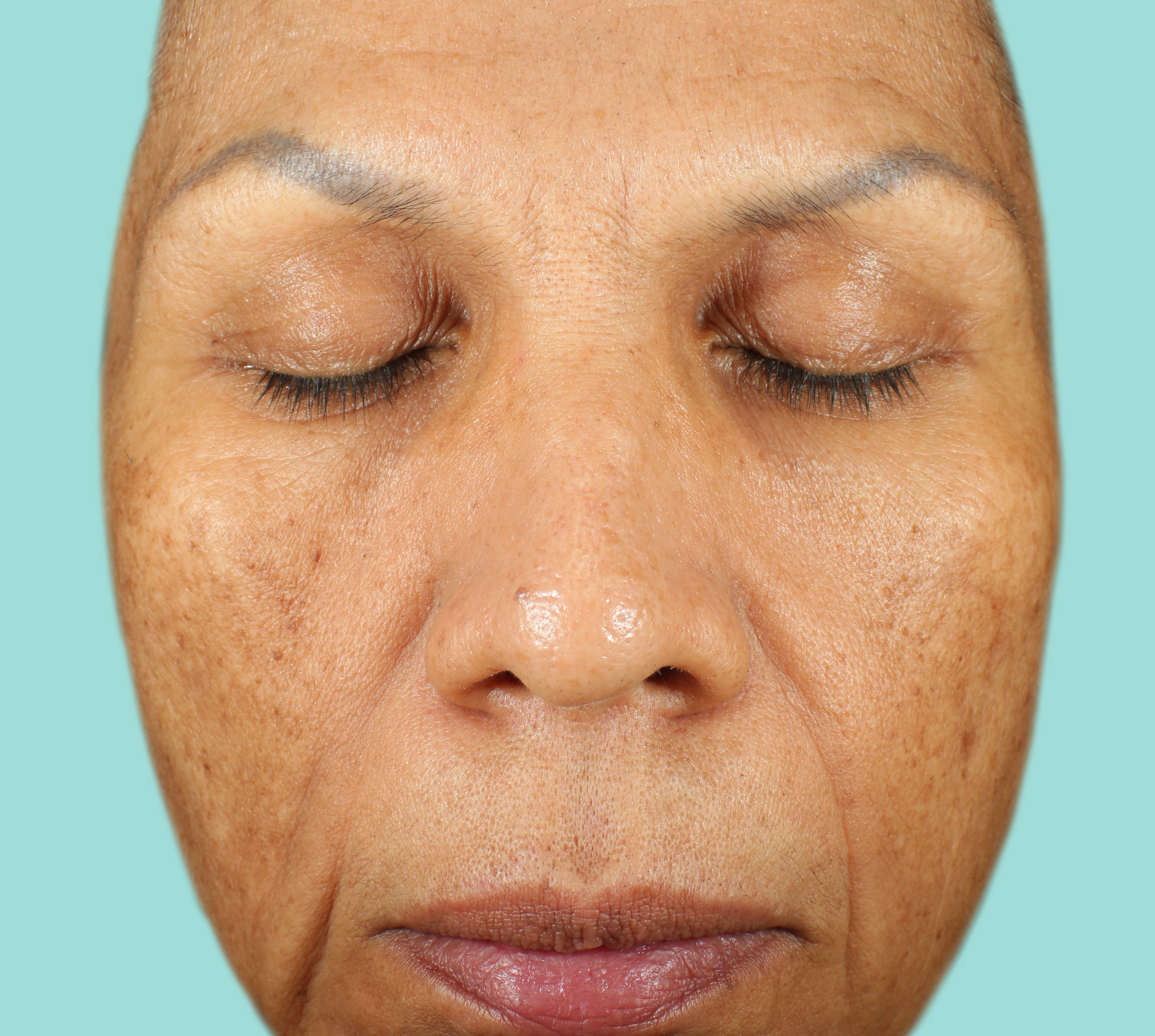 CJH Baseline Front View NEOCUTIS® treatment