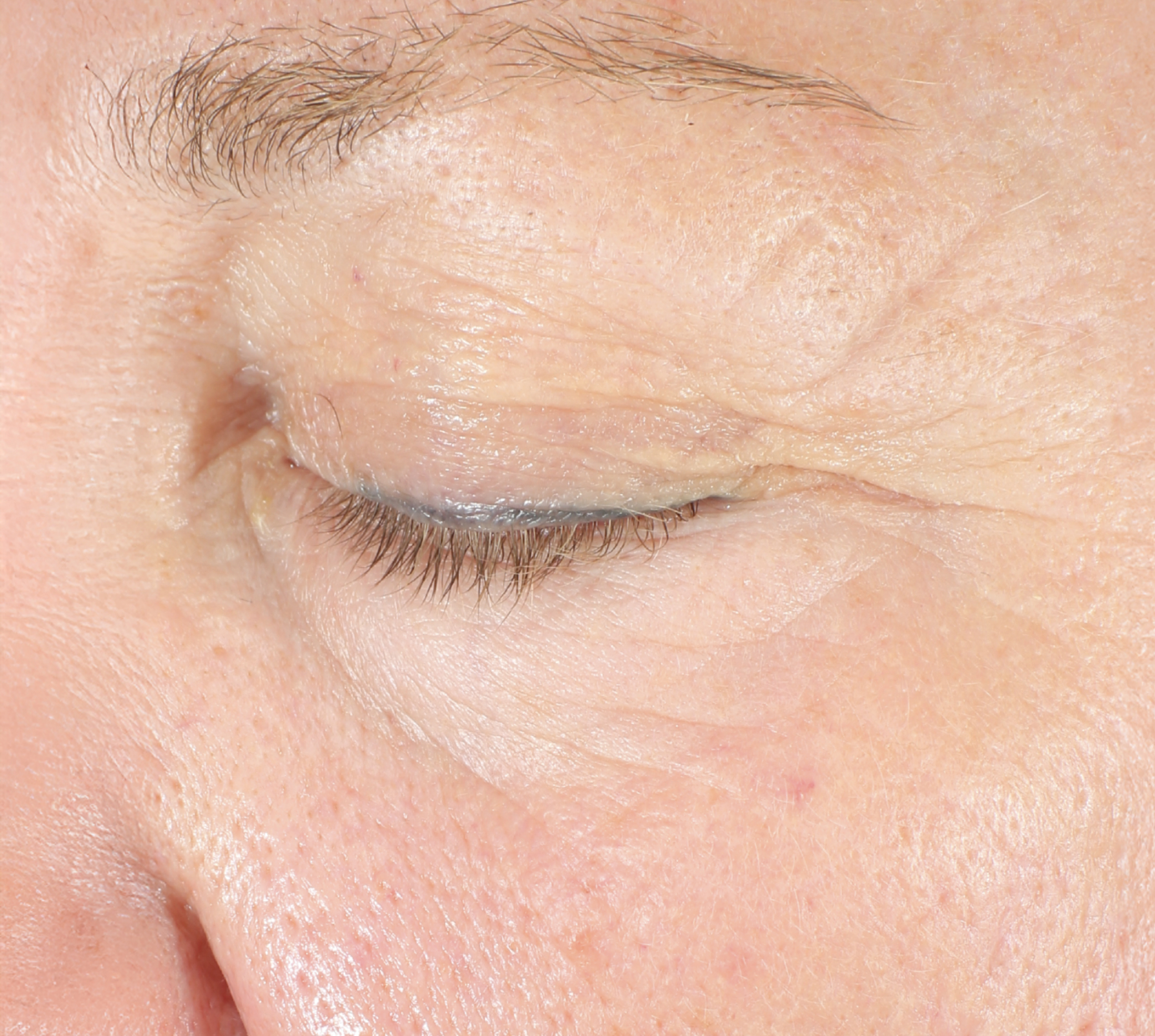 Lumiére Firm before NEOCUTIS® treatment