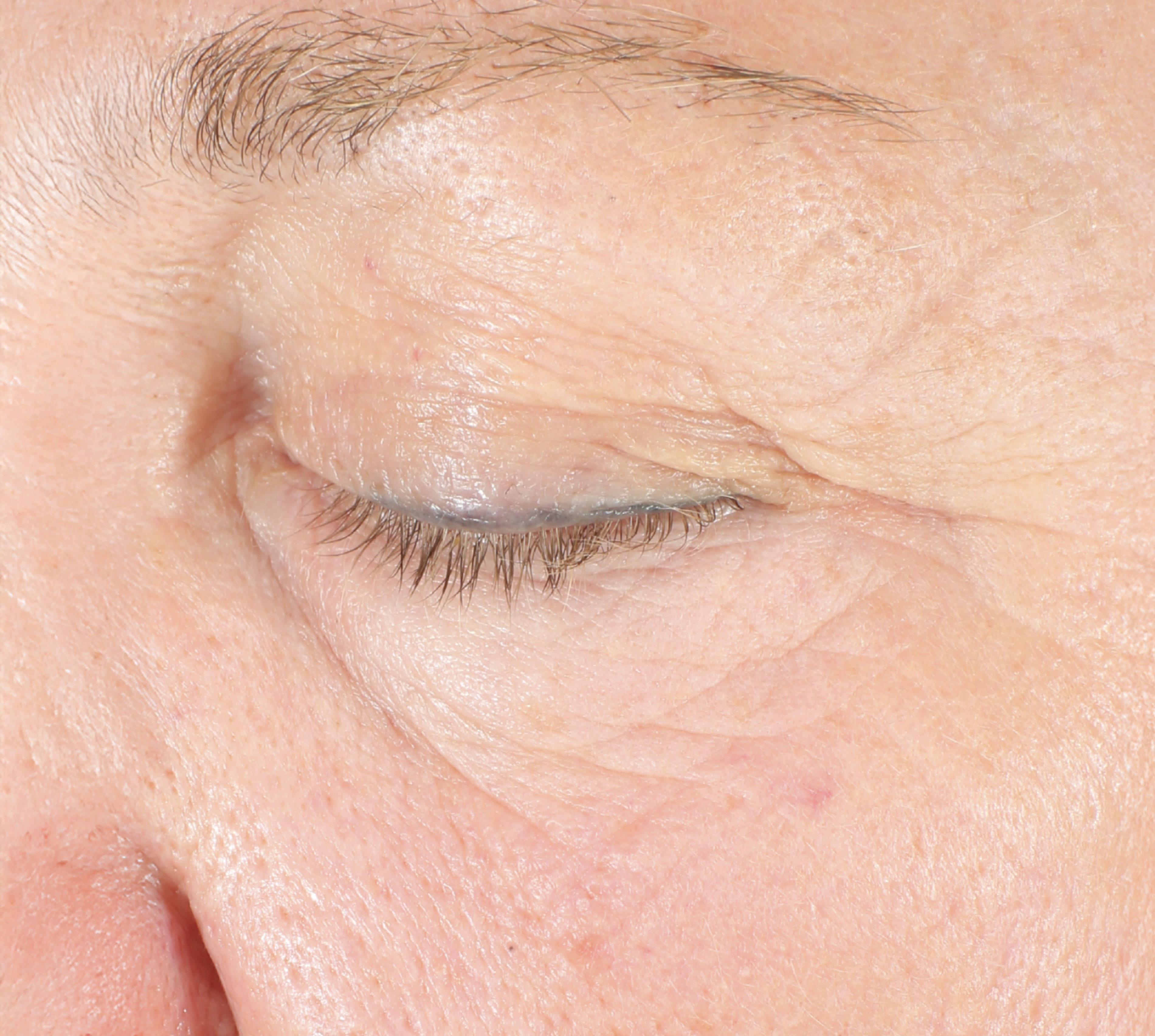 Lumiére Firm after NEOCUTIS® treatment