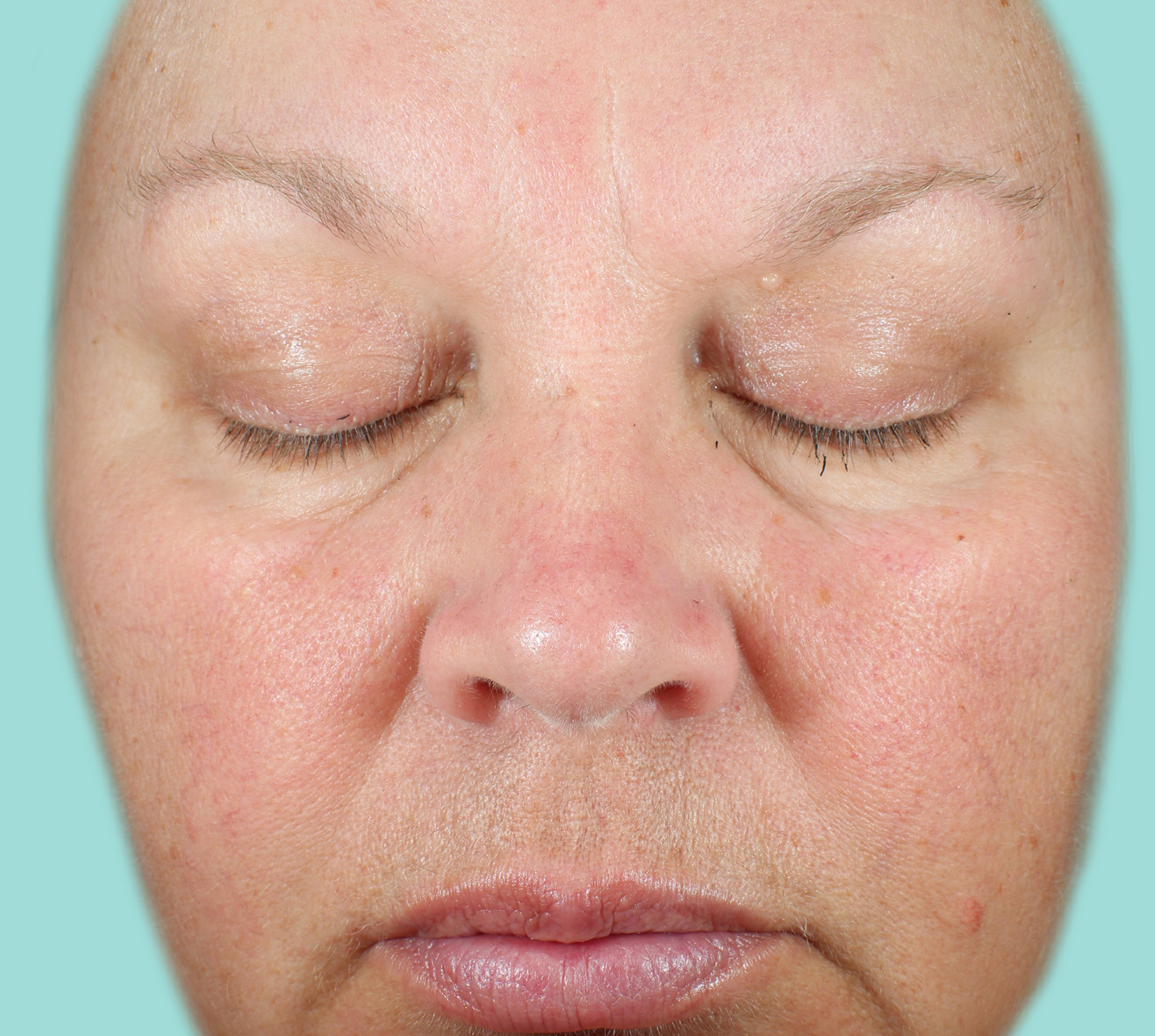Patient A before NEOCUTIS® treatment