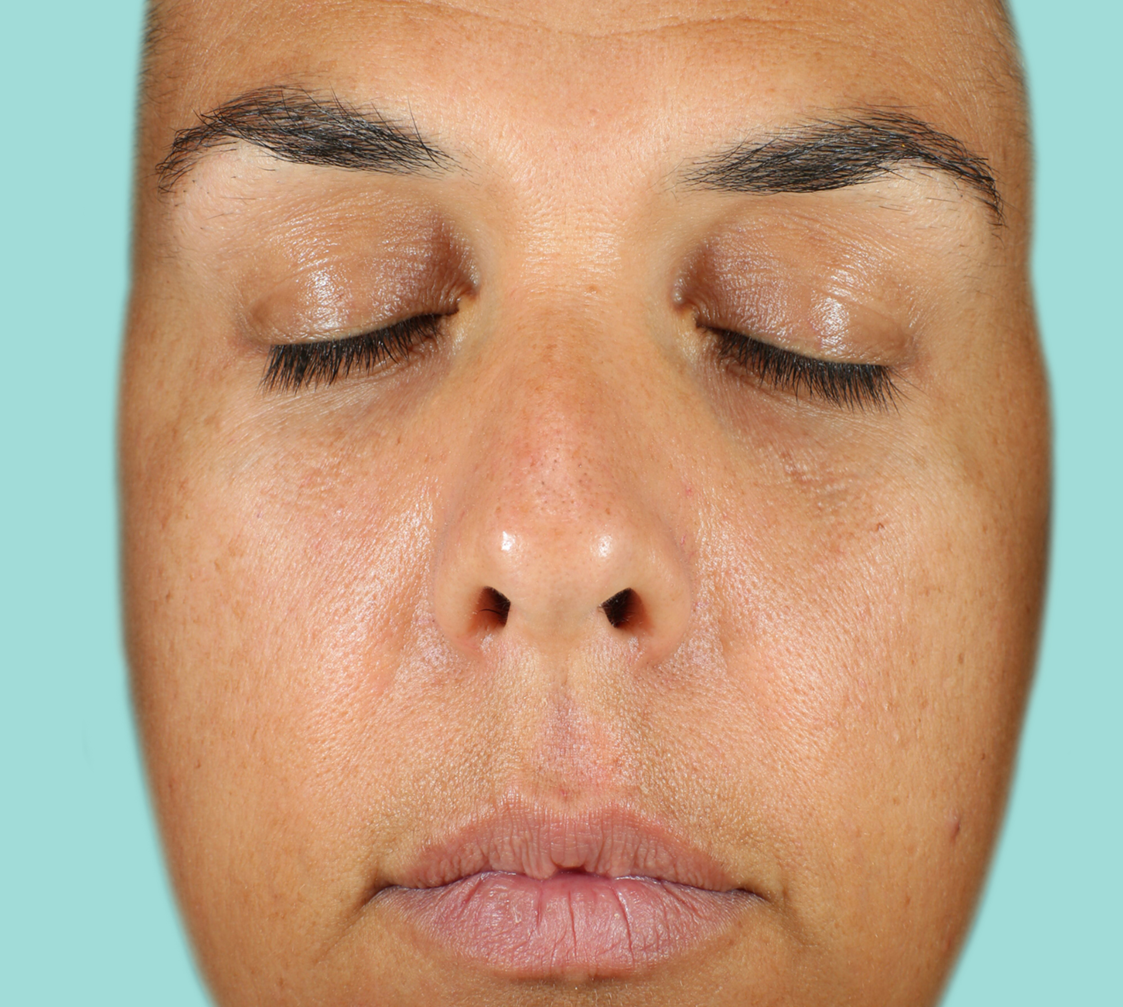 Patient B Before NEOCUTIS® treatment
