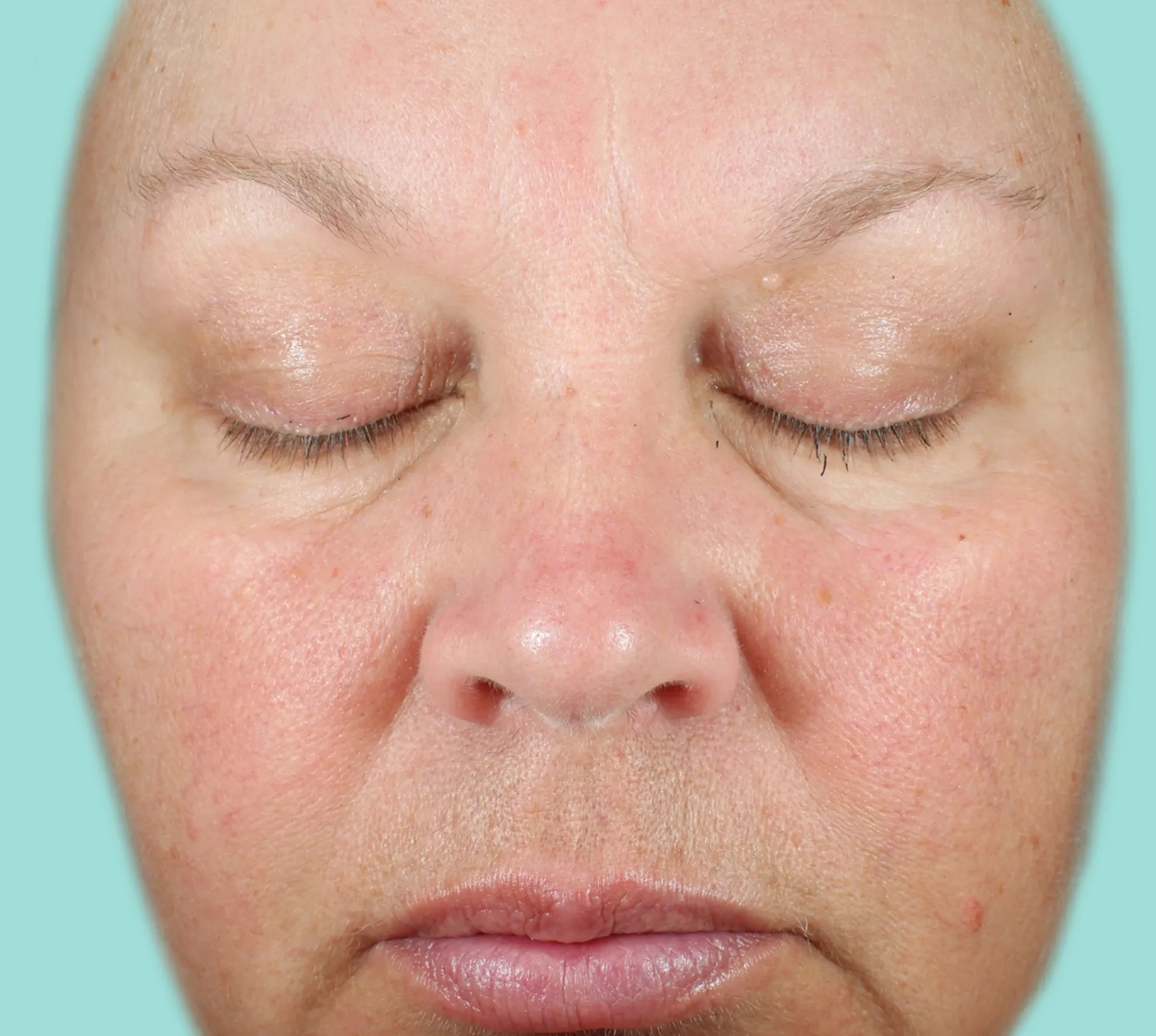 Patient A before NEOCUTIS® treatment
