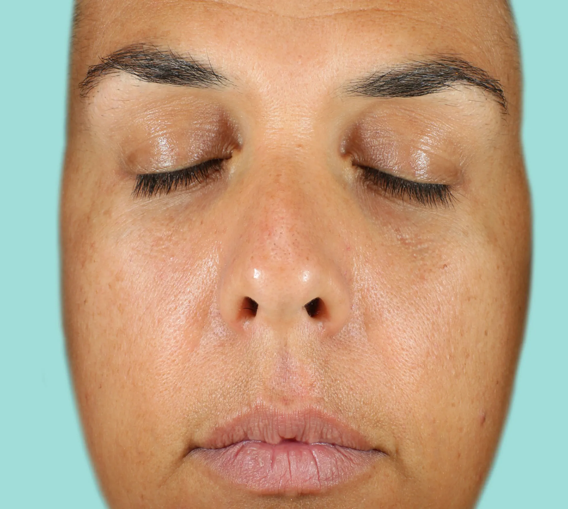 Patient B Before NEOCUTIS® treatment