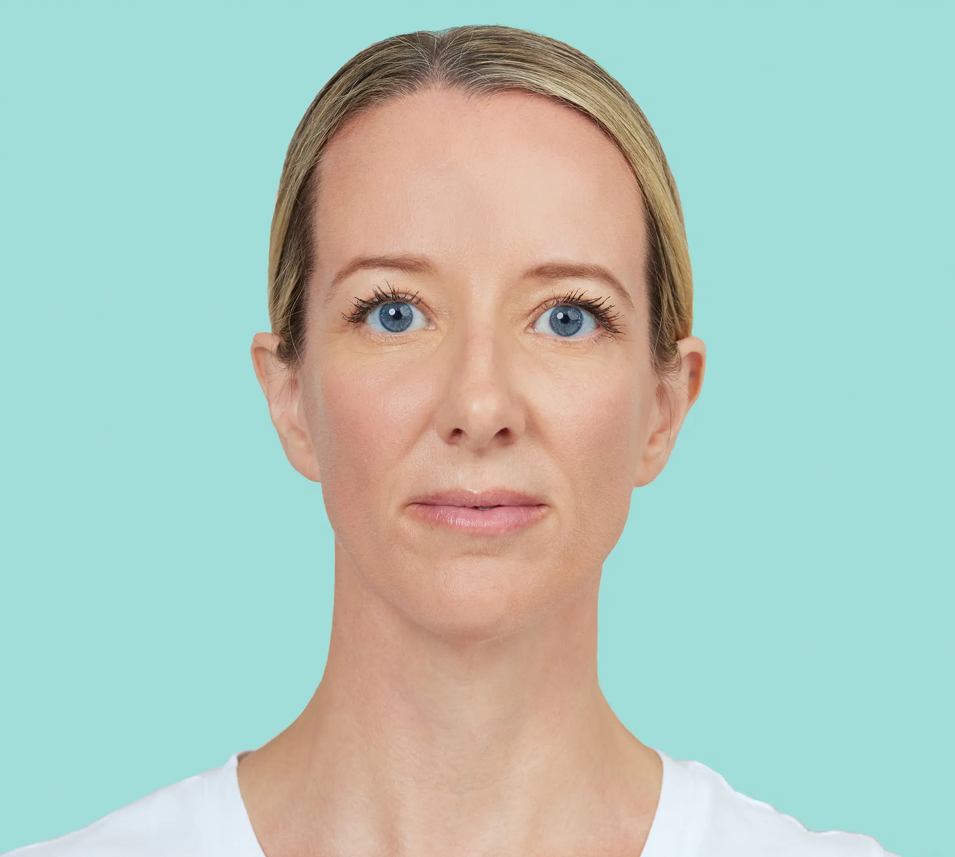 Amy front before RADIESSE® treatment