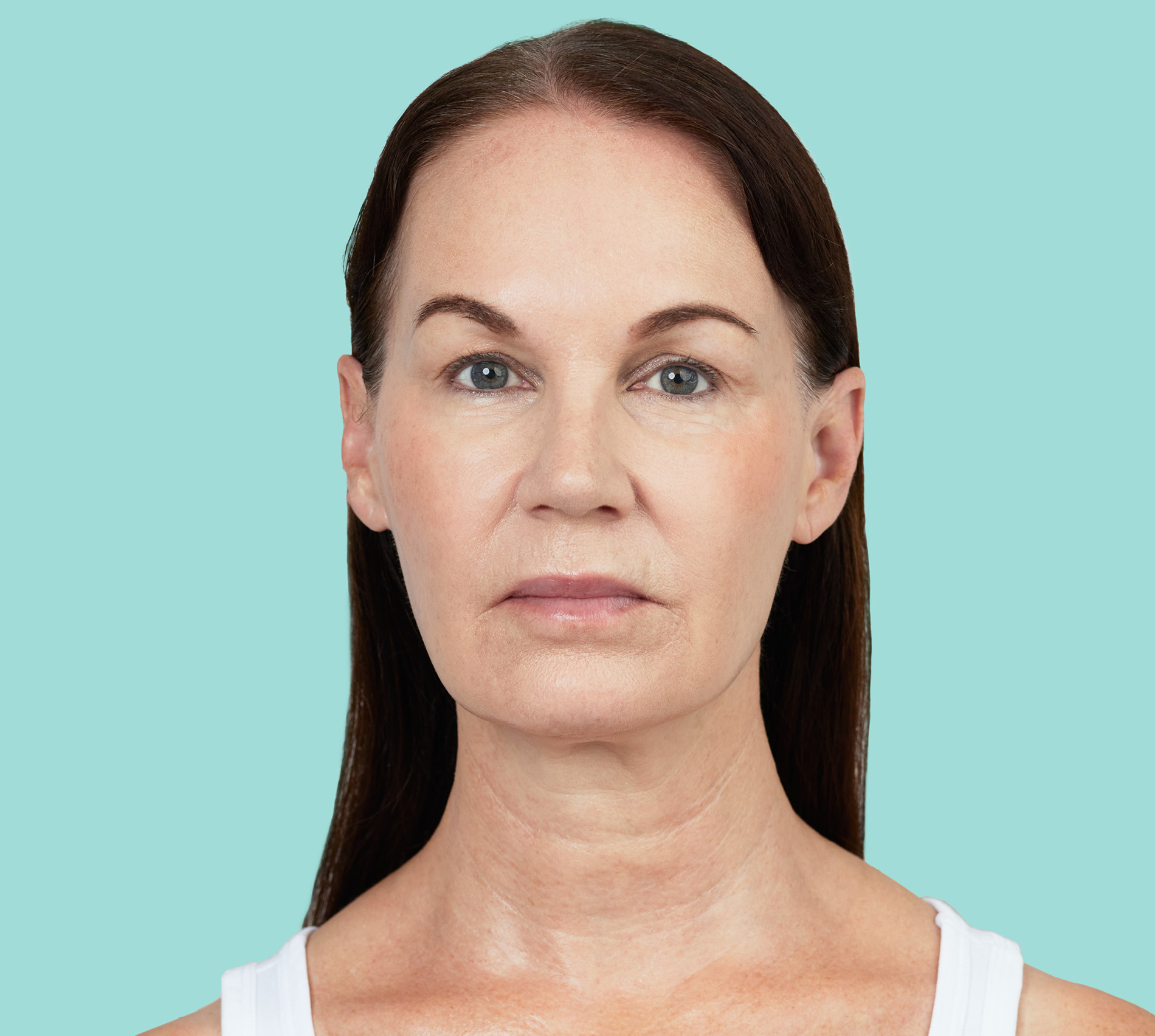 Beth front before RADIESSE® treatment