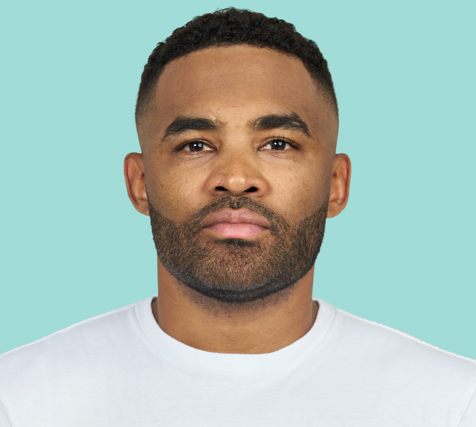 Brandon Kimbrough front after RADIESSE® treatment