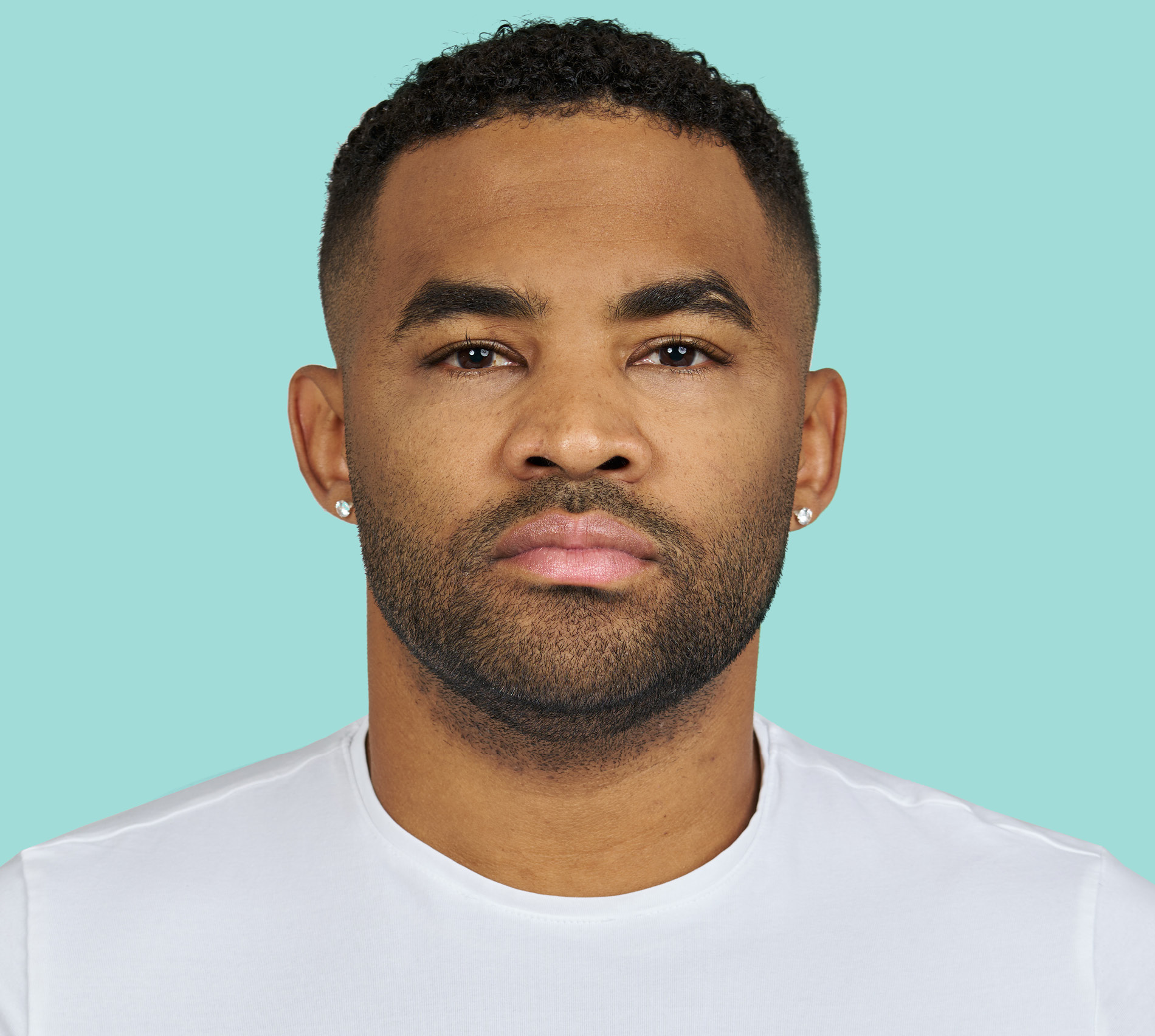 Brandon Kimbrough front before RADIESSE® treatment