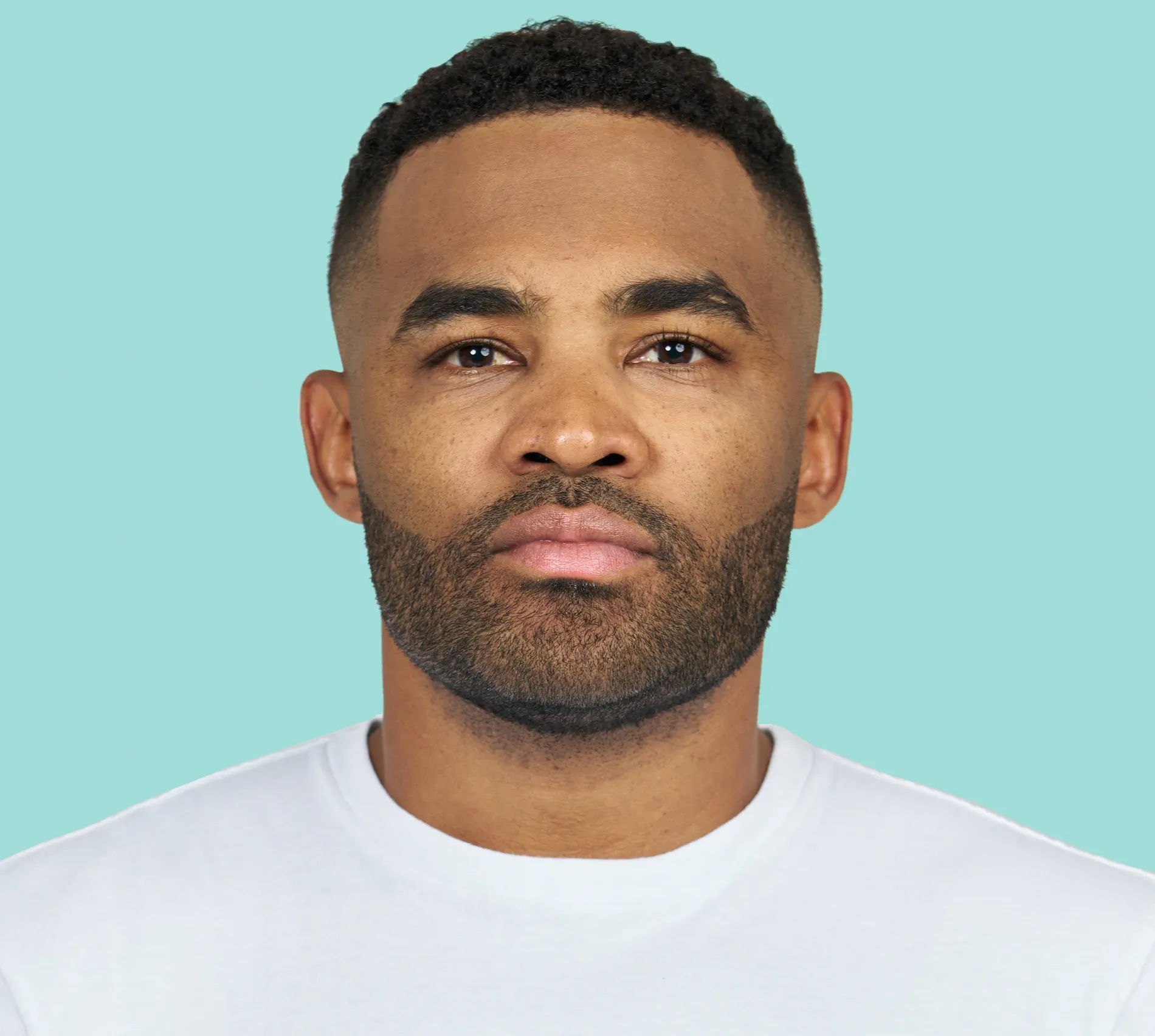 Brandon Kimbrough front after RADIESSE® treatment