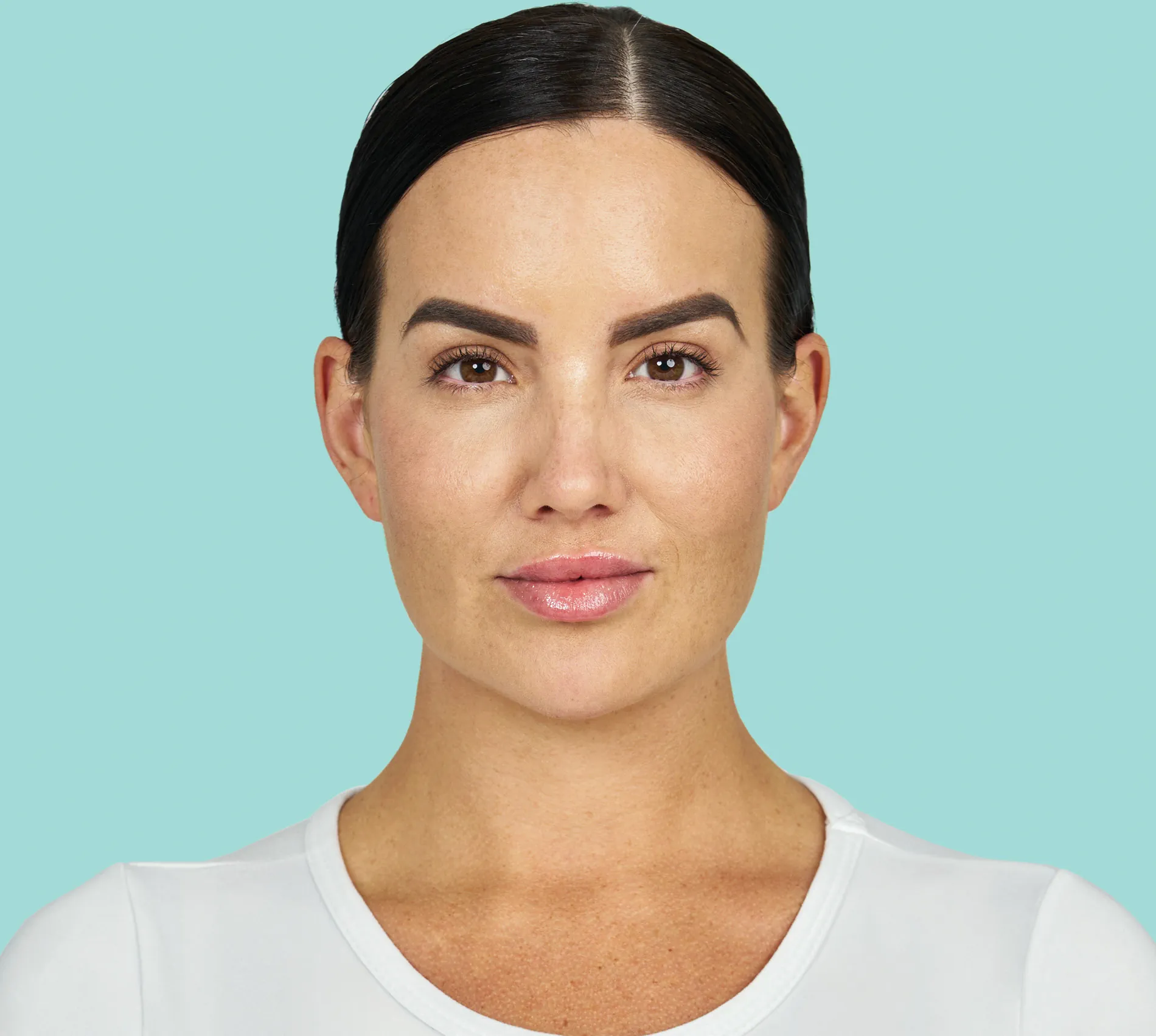 Brigitte Martinez front before RADIESSE® treatment