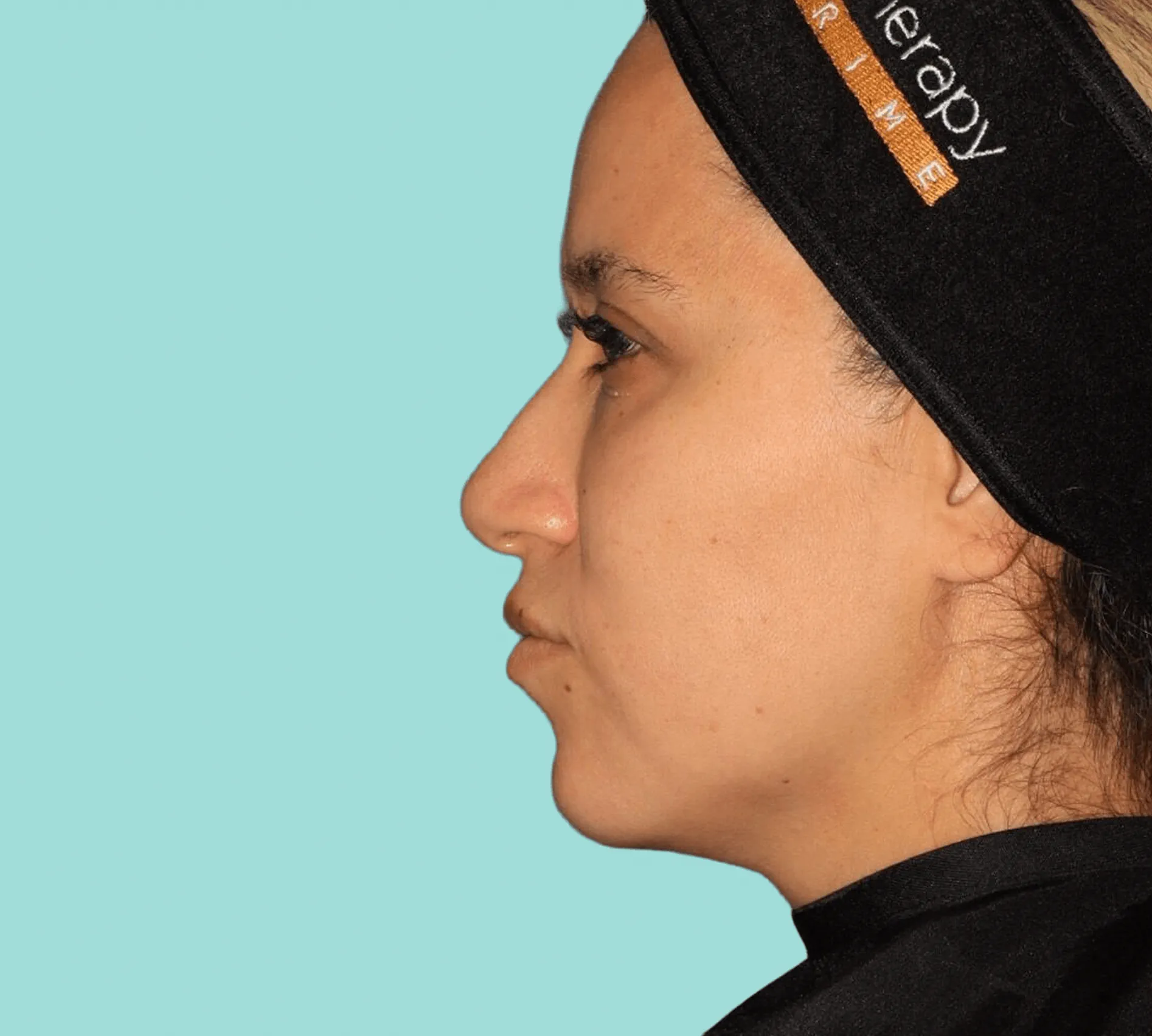 Before Treatment
