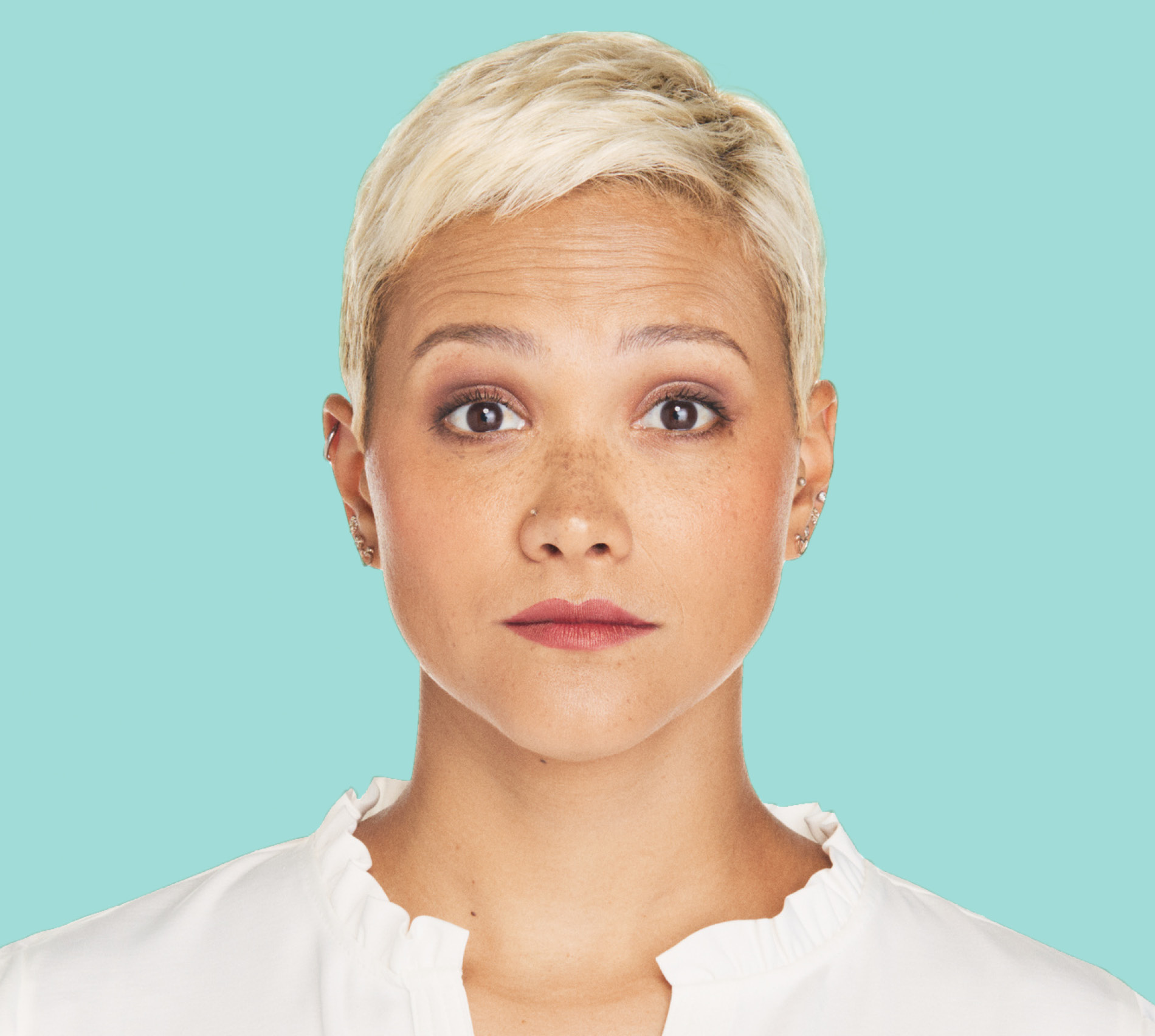 Alex after XEOMIN® treatment