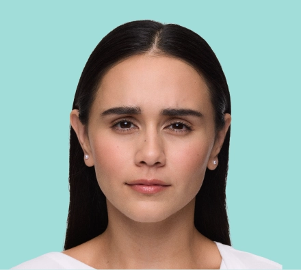 Before XEOMIN® treatment