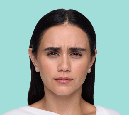 Before XEOMIN® treatment